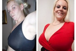 Hipnoterapi Bikin Payudara Perempuan Ini Meningkat 2 Ukuran