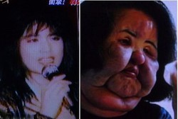 Sudah 10 Kali Operasi, Wajah Masih Amburadul Akibat Disuntik Minyak Goreng