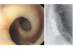 Tiap Kali Menelan Makanan, Kerongkongan Nenek Ini Membentuk Spiral