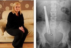 Ya Ampun, Tang 18 Cm Bersemayam di Tubuh Perempuan Ini