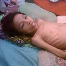 Diserang Kanker Tulang, Siswa SMP di Jember Hanya Bisa Terbaring