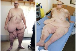 Mantan Pria Tergemuk di Dunia Pose Telanjang dengan Kulit Gelambirnya