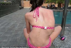 Gadis Berpunggung Bengkok 100 Derajat Ini Akhirnya Berhasil Dioperasi