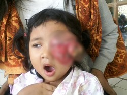 Tolong! Balita di Depok Menderita Kanker Mata dan Butuh Biaya Operasi