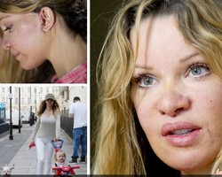 Gara-gara 350 Kali Operasi Plastik, Model Ini Jadi Tak Bisa Senyum