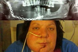 Tulang Kena Kanker, Rahang Wanita Ini Diganti Pakai Rantai Sepeda