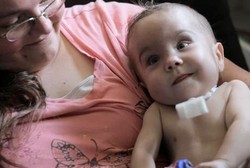 Tak Punya Batang Tenggorok, Nyawa Bayi Selamat Berkat Pipa Plastik