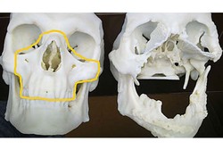Pria Polandia Ini Mendapat Transplantasi Wajah Tercepat Pasca Kecelakaan