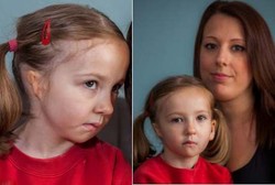 Gadis Malang yang Terlahir dengan Satu Buah Telinga