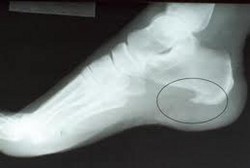 Ada Gambar Jalu Ayam di Foto Rontgen Kaki, Apa Artinya?