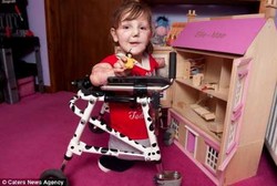 76 Operasi dan 3 Amputasi karena Meningitis, Ellie-Mae tetap Ceria