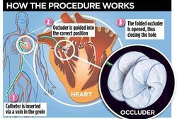 Terobosan Baru, Sedia Payung Sebelum Kena Serangan Jantung
