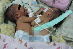 RSCM Sukses Pisahkan Bayi Kembar Siam dengan Usia Termuda di Indonesia