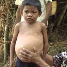 Kelainan Usus Atas, Imam Bukhori akan Dirujuk ke RSU Soetomo