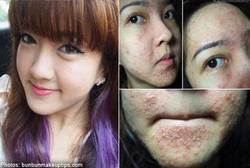 Wajah Wanita Cantik Ini Jadi Rusak Gara-gara Salah Facial