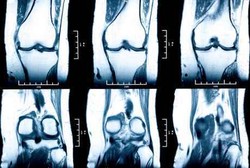 Kanker Tulang Rupanya Sudah Ada Sejak 120.000 Tahun Lalu