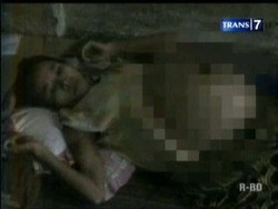 Perut Wanita Membengkak Sebesar Drum