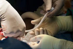 Sakit Ginjal, Pasien Ini Terima Pembuluh Darah Buatan Pertama