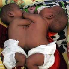 RSU Soetomo Rawat Bayi Kembar Siam Dempet Perut