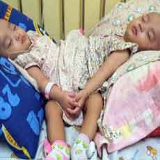 Tim Dokter RSU Soetomo Bantu Operasi Kembar Siam Dempet Pinggul