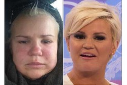 Ingin Cantik dengan Suntik Darah, Kerry Malah Jadi Manusia Gajah