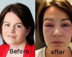 Setelah Extension Bulu Mata, Mata Wanita Ini Jadi Bengkak