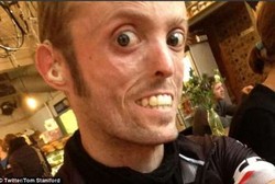 Kena Penyakit Sangat Langka, Pria Ini Tak Bisa Gemuk Meski Banyak Makan