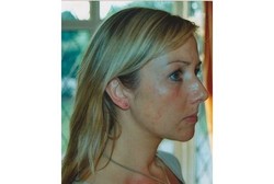 Gara-gara Alergi Nikel, Wanita Ini Tak Bisa Memakai Bra