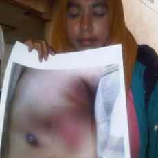 Pasien Arizal Ditangani Tim Bedah Otot Satu-satunya di Surabaya