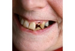 Awas, Gigi Ompong Bikin Cepat Pikun