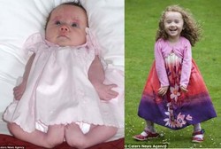 Terlahir dengan Kaki Katak, Si Kecil Emma Akhirnya Bisa Berjalan