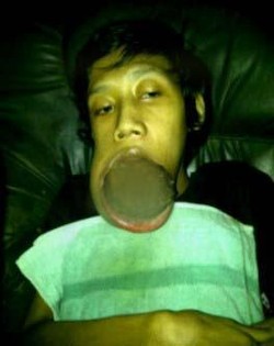 Tolong! Remaja Penderita Kanker Mulut Ini Butuh Biaya Berobat