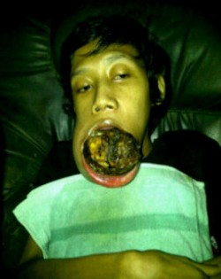 Tolong, Aldy Anak Buruh Tani ini Butuh Biaya untuk Operasi Kanker Mulut