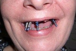 Bermula dari Gigi Goyah, Seluruh Gigi Atas Malah Diganti Sekrup Logam