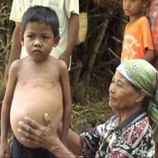 Operasi Bocah 9 Tahun dengan Perut Membesar Sukses