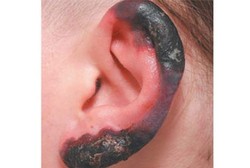 Jaringan Kulit Rusak, Kuping dan Hidung Wanita Ini Gosong