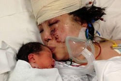 Luka Parah Akibat Kecelakaan, Ibu Ini Berhasil Lahirkan Bayinya