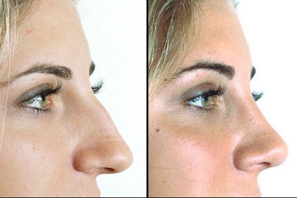 Melongok Foto-foto Before After, Beginilah Hebatnya Operasi Plastik