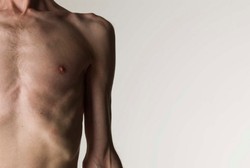 Tubuh Tinggal Kulit Pembungkus Tulang, Inilah Orang-orang Terkurus Sedunia