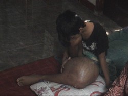 Tolong, Siswa Miskin Ini Tak Bisa Sekolah karena Benjolan Besar di Pahanya