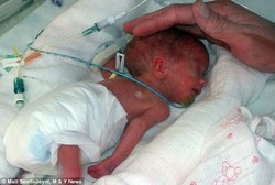 Kisah Annabel Hately yang Saat Lahir Hampir Seukuran Pulpen