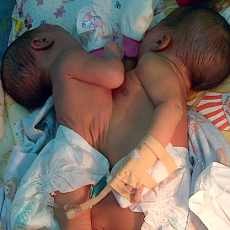 Bayi Kembar Siam Kediri Dirujuk ke Surabaya