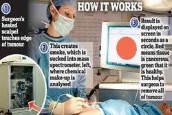 Operasi Kanker Jadi lebih Mudah dengan Pisau Bedah Pintar Ini
