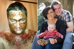 Gara-gara Eksim Parah, Ayah Baru Ini Harus Tinggal Jauh dari Bayinya