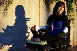 Tergigit Anjing Peliharaan, Kaki dan Tangan Wanita Ini Harus Diamputasi