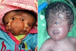6 Bayi yang Terlahir dengan Kondisi Langka, Punya 2 Wajah Hingga 1 Mata