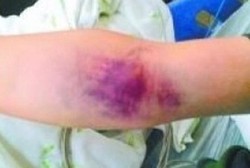 Pria Ini Memar-memar Usai Makan Kebab yang Diduga Mengandung Racun Tikus