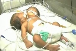 Bayi Berkepala 2 Lahir di India, Dokter Berjuang Selamatkan Hidupnya 