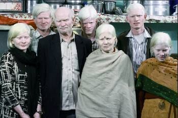 Mengintip Kehidupan Keluarga Albino Terbesar di Dunia