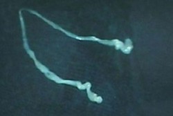 Setahun Sakit Kepala Parah, Ternyata Ada Parasit 15 Cm di Dalam Otak